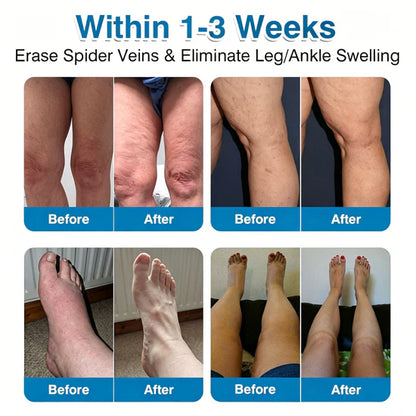 🇨🇦👨‍⚕️✅Trilumia® VeinRepair Microneedle Patch Roll⚡Instant Relief, Long-Term Results