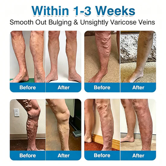 🇨🇦👨‍⚕️✅Trilumia® VeinRepair Microneedle Patch Roll⚡Instant Relief, Long-Term Results