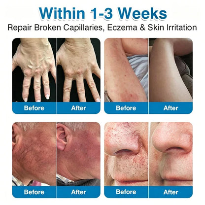 🇨🇦👨‍⚕️✅Trilumia® VeinRepair Microneedle Patch Roll⚡Instant Relief, Long-Term Results